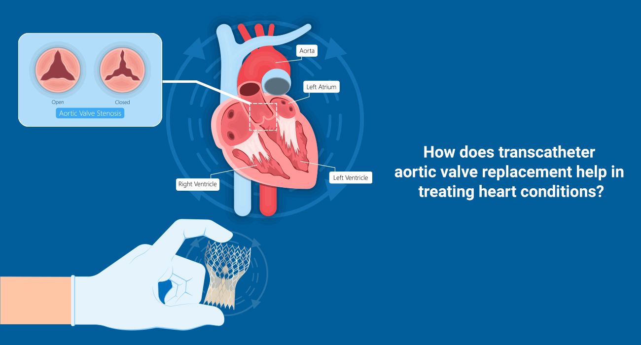 How Does Transcatheter Aortic Valve Replacement Help In Treating Heart ...